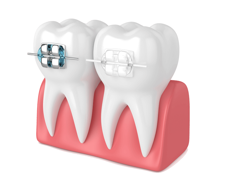 Are braces right for me?