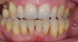 After treatment After treatment