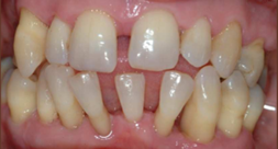 Before treatment Before Treatment