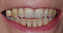 After treatment After treatment