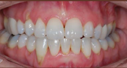 After treatment After treatment
