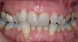 Before treatment Before Treatment