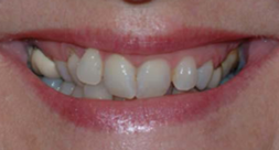 Before treatment Before Treatment