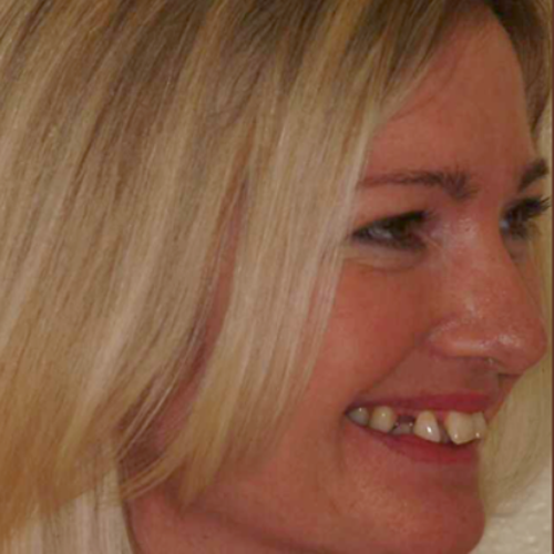Joanne before treatment Joanne before treatment